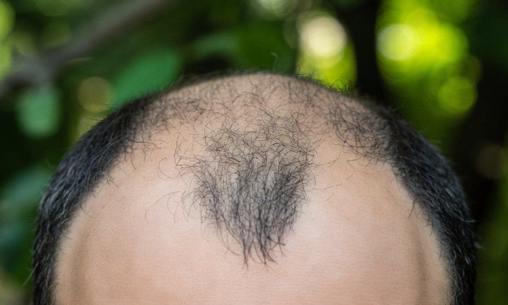 Calvicie en los hombres.